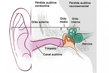 perdida auditiva